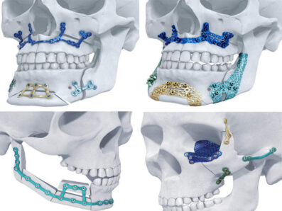 FDA Clears Materialise’s 3D-printed Maxillofacial Implants - Medical ...