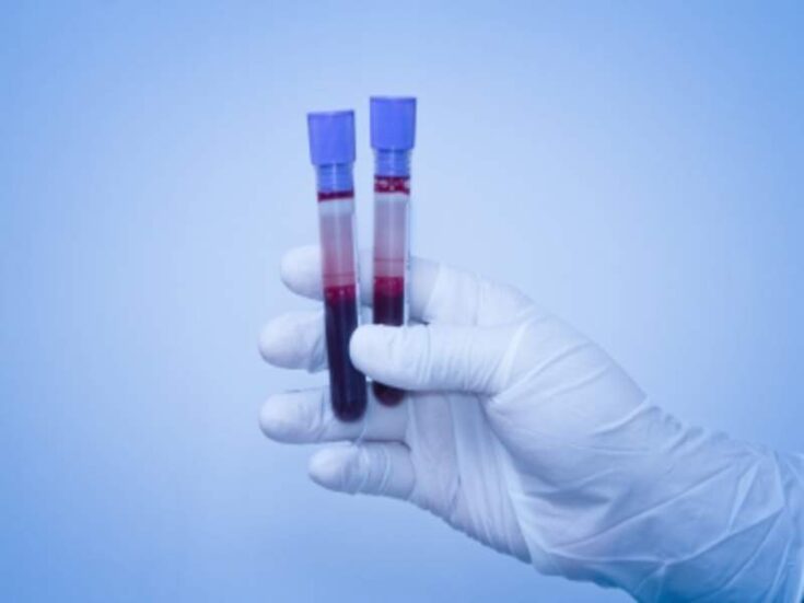 Grail Studies STRIVE Blood Tests To Detect Cancer Early - Medical ...