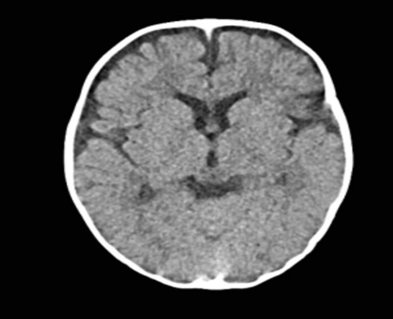 Radiation From CT Scans Can Increase Risk Of Brain Cancer In Children