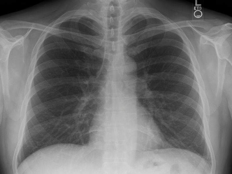pneumothorax lung x ray