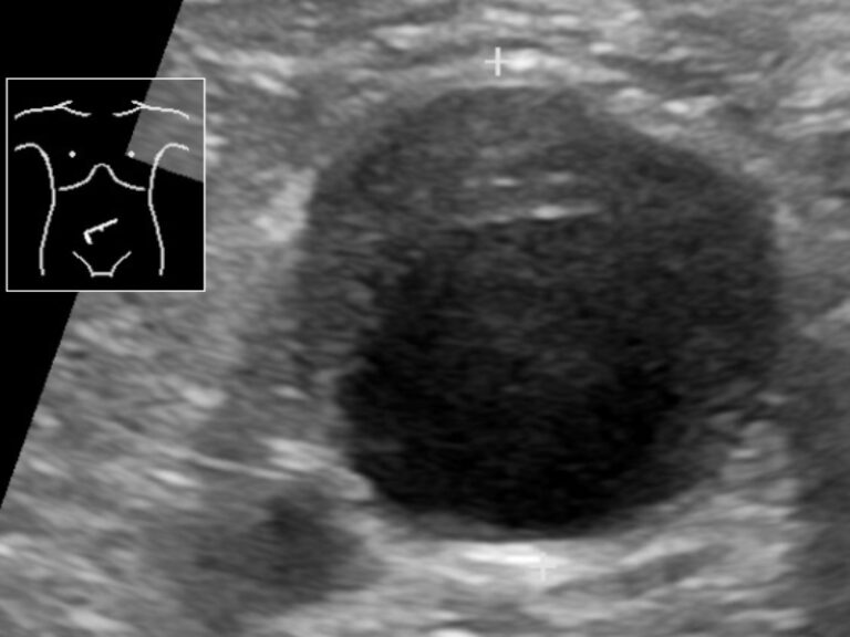 Endologix completes enrolment in EndoVascular aneurysm system trial