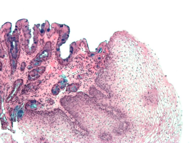 NEC develops AI technology for Barrett’s neoplasia detection