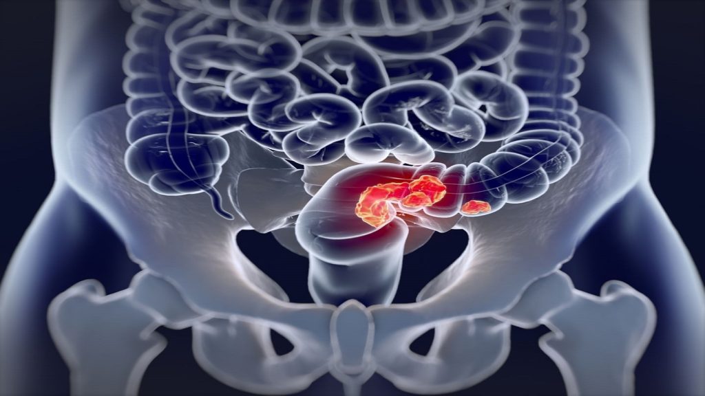 Medical Device Network   Colorectal Test 1024x576 