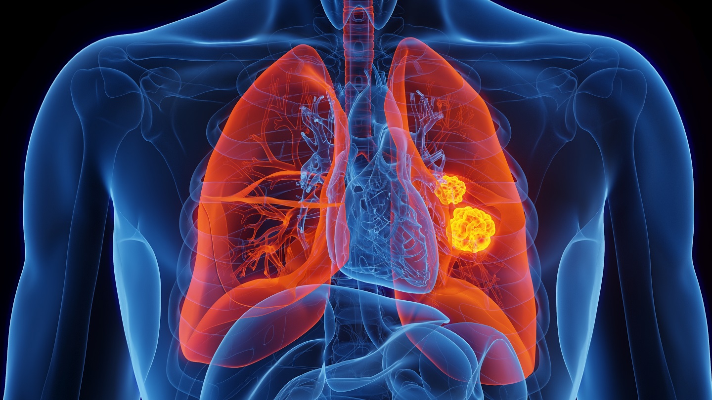 Johns Hopkins announces new blood test for lung cancer detection