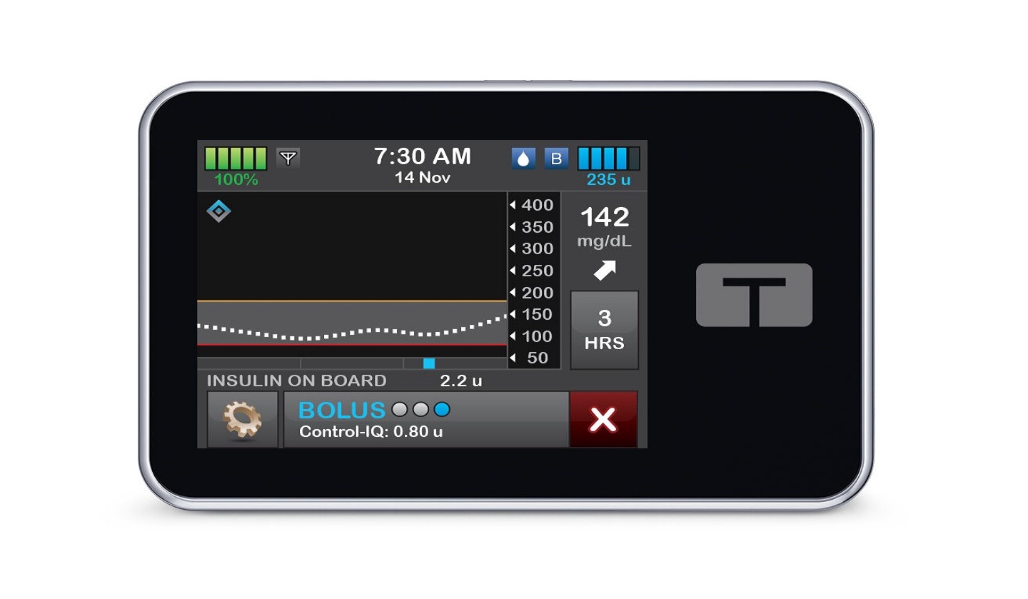 FDA clears Tandem’s Control-IQ+ technology for type 2 diabetes