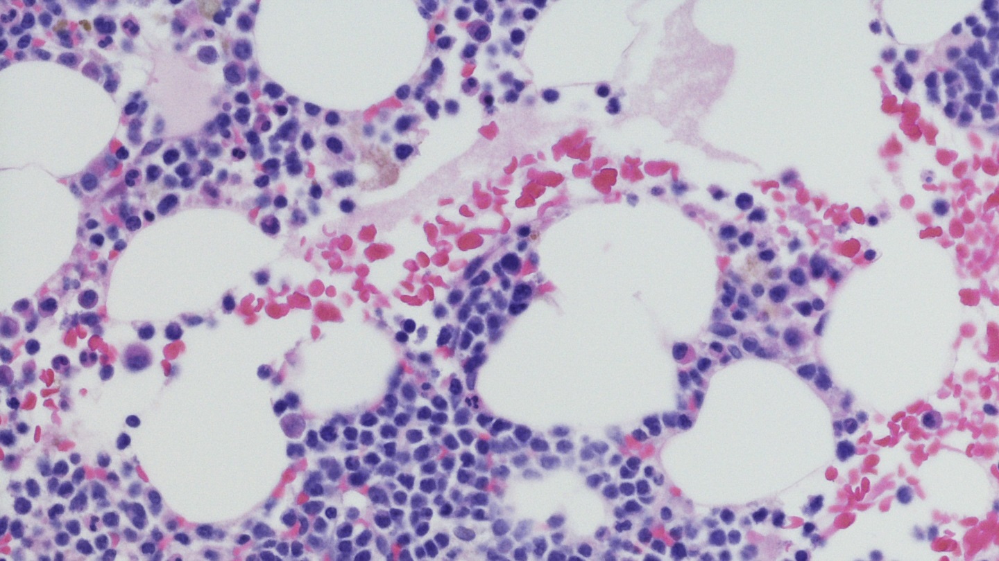 SkylineDx study highlights value in combined myeloma diagnostic approach